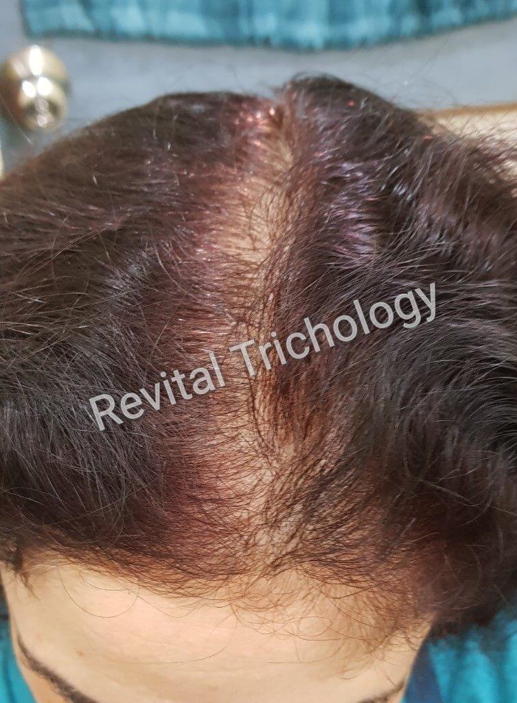 Before And After Photos - Best Trichologist In Mumbai