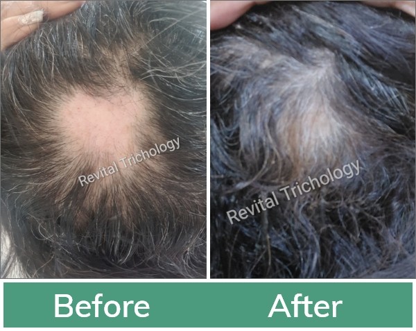 Hair loss treatment in Mumbai