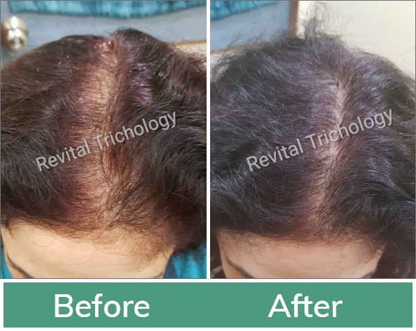 Hair Loss Specialist For Women- Revital Trichology