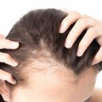 Hair loss treatment in hormonal imbalance