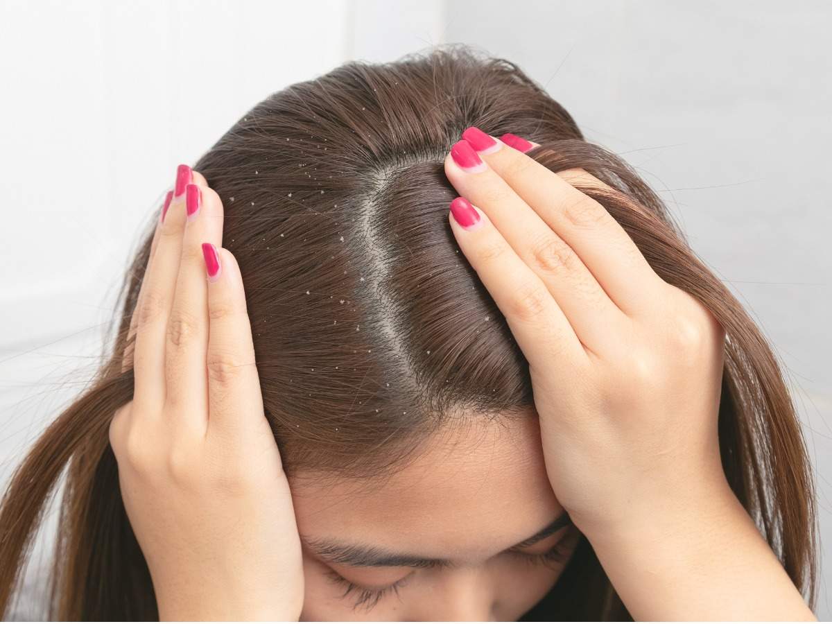 hair loss treatment in PCOS,