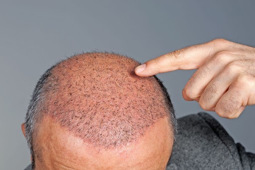 Hair Transplant - Why it Became So Popular